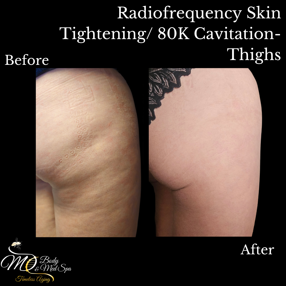 Comparison of thighs before and after radiofrequency skin tightening/80K cavitation.