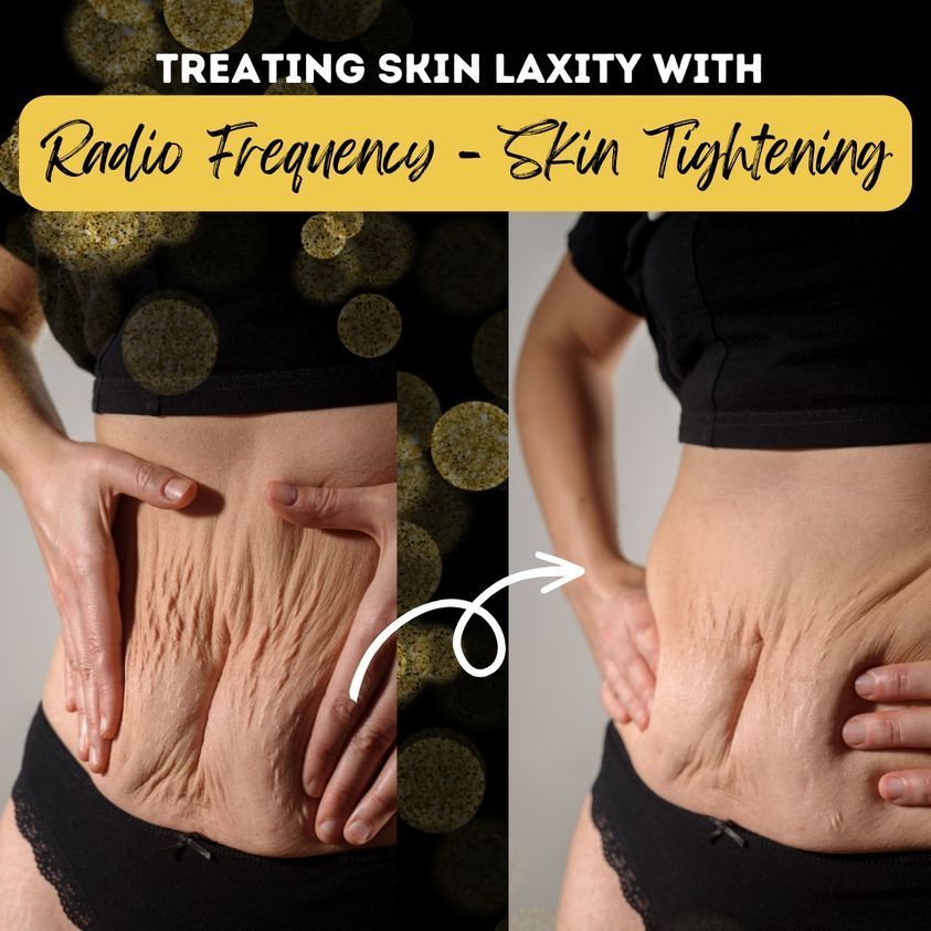 Before and after skin laxity treatment. Woman's abdomen before (wrinkled) and after radio frequency treatment (smooth).