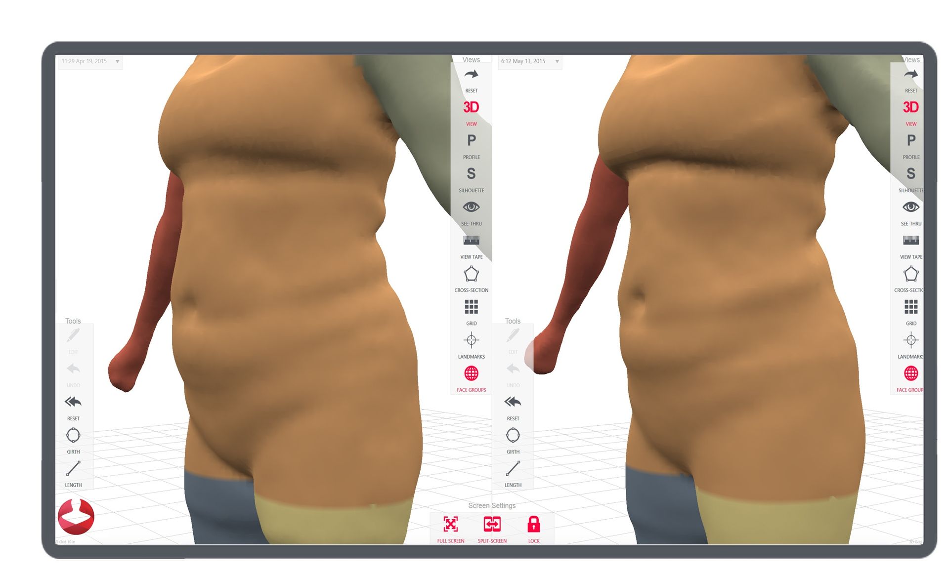 Two side-by-side 3D models of a torso with visible fat rolls, displayed on a screen. The models are beige and have brown arms.