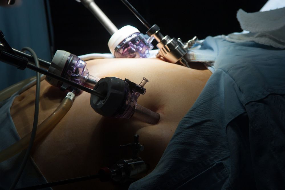A Person is Being Operated on by a Surgeon in a Dark Room — Brisbane Upper GI Surgery in Chermside, QLD