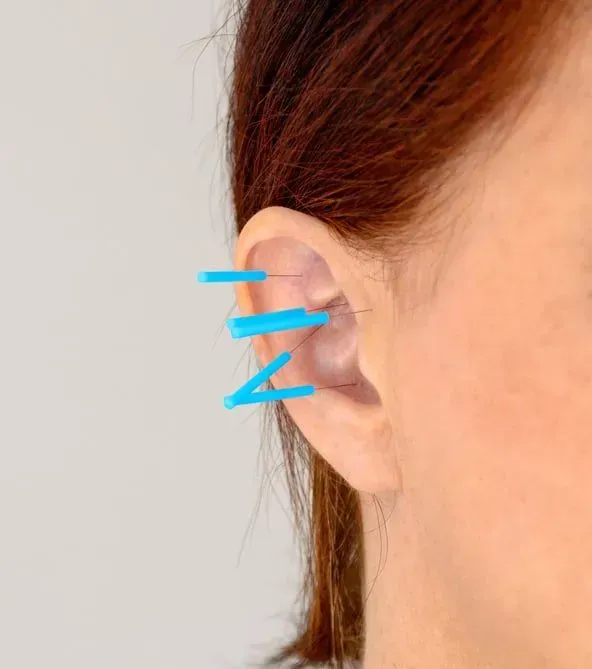 Ear with blue acupuncture needles inserted.
