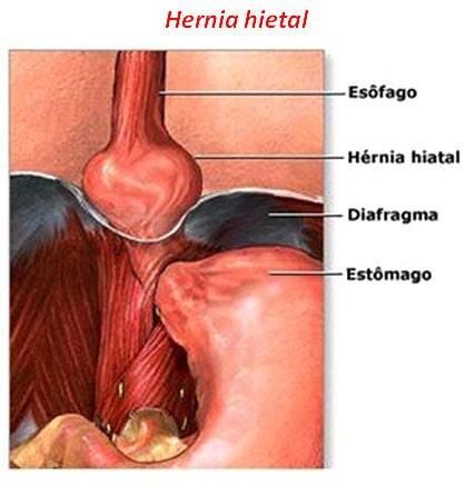 Un diagrama del estómago de una persona con las palabras hernia hietal en la parte superior.