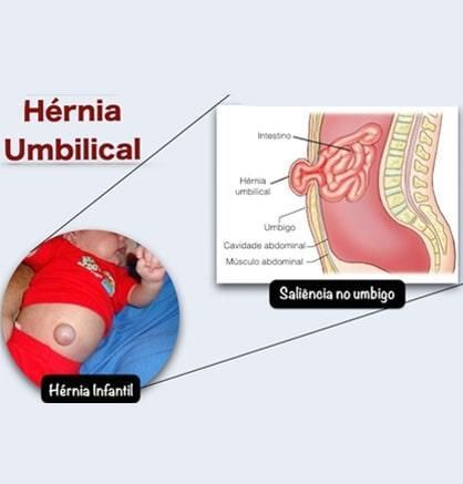 Una foto de un bebé con una hernia umbilical.