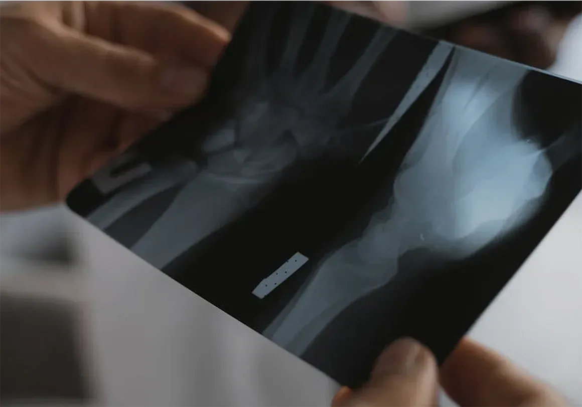 Person holding an X-ray of a forearm and wrist, with a small, rectangular object visible within the arm.