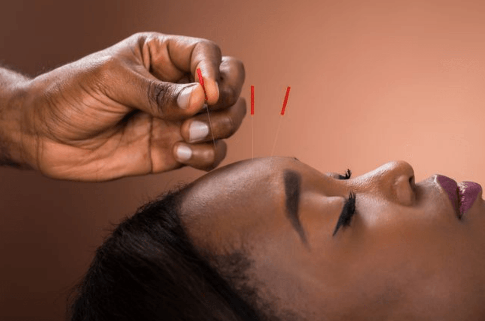 Woman having acupuncture  in her forehead
