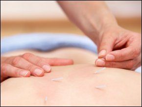 Acupuncture