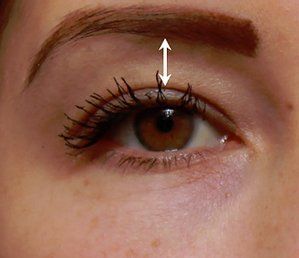 After Eye Dermal Filler — Poughkeepsie, NY — Wellness and Skincare Medical Center