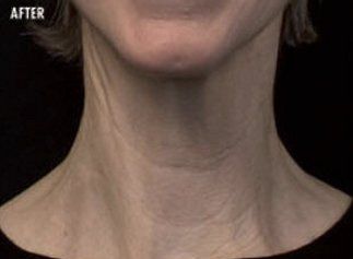 After Nefertiti Neck Lift​ — Poughkeepsie, NY — Wellness and Skincare Medical Center