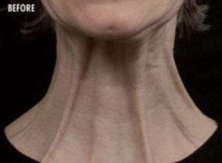 Before Nefertiti Neck Lift​ — Poughkeepsie, NY — Wellness and Skincare Medical Center