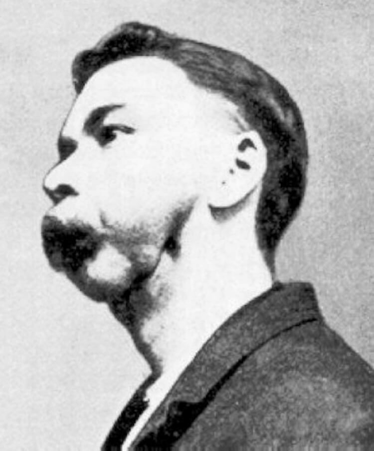Image of a man with Phossy Jaw