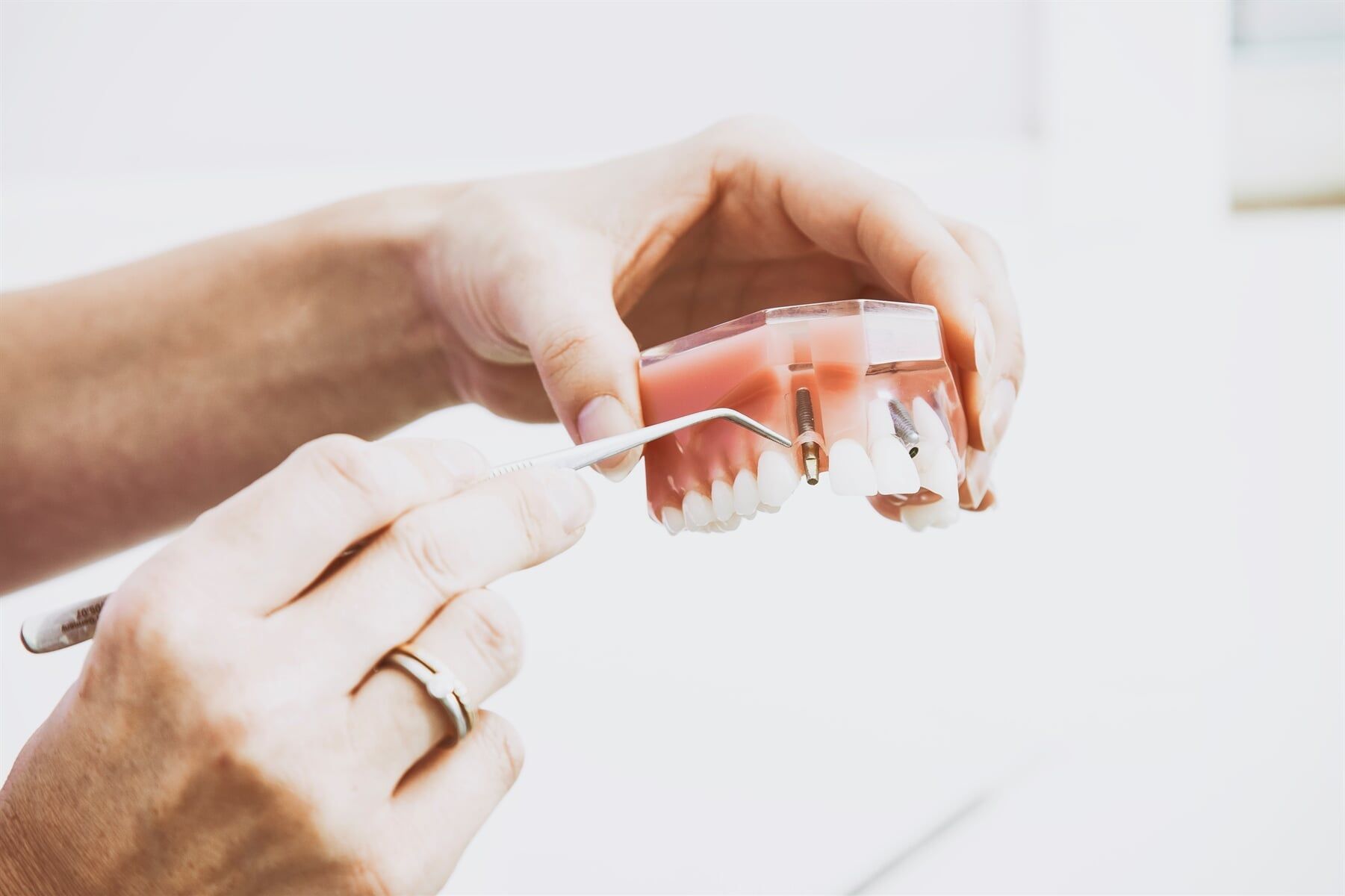 Fixed Denture Implants — Denture in Mackay, QLD
