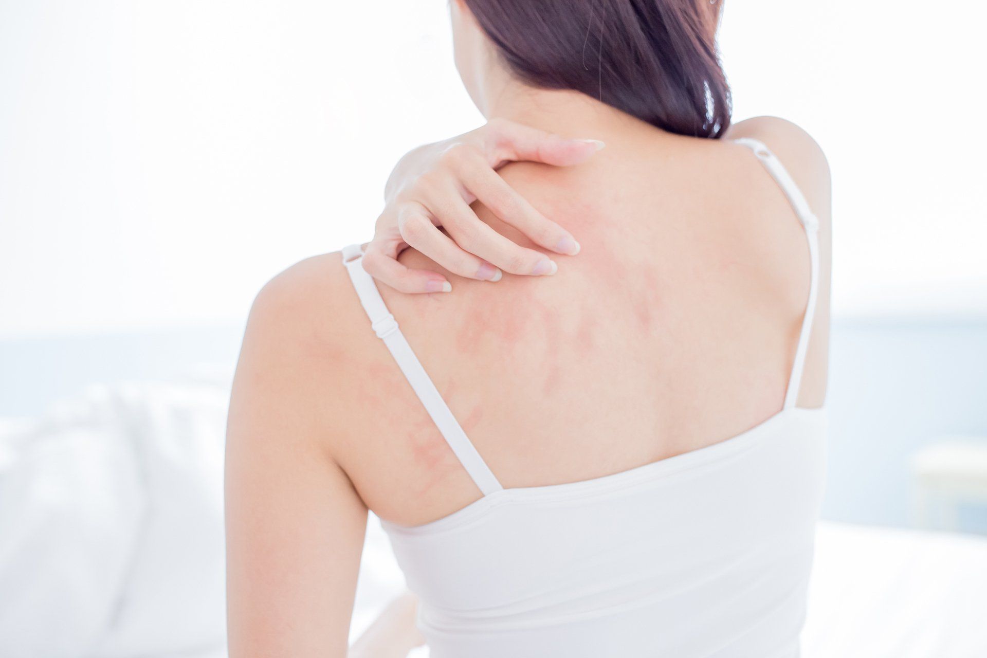 Eczema — DeSoto TX — Allergic Diagnostic & Treatment Clinic