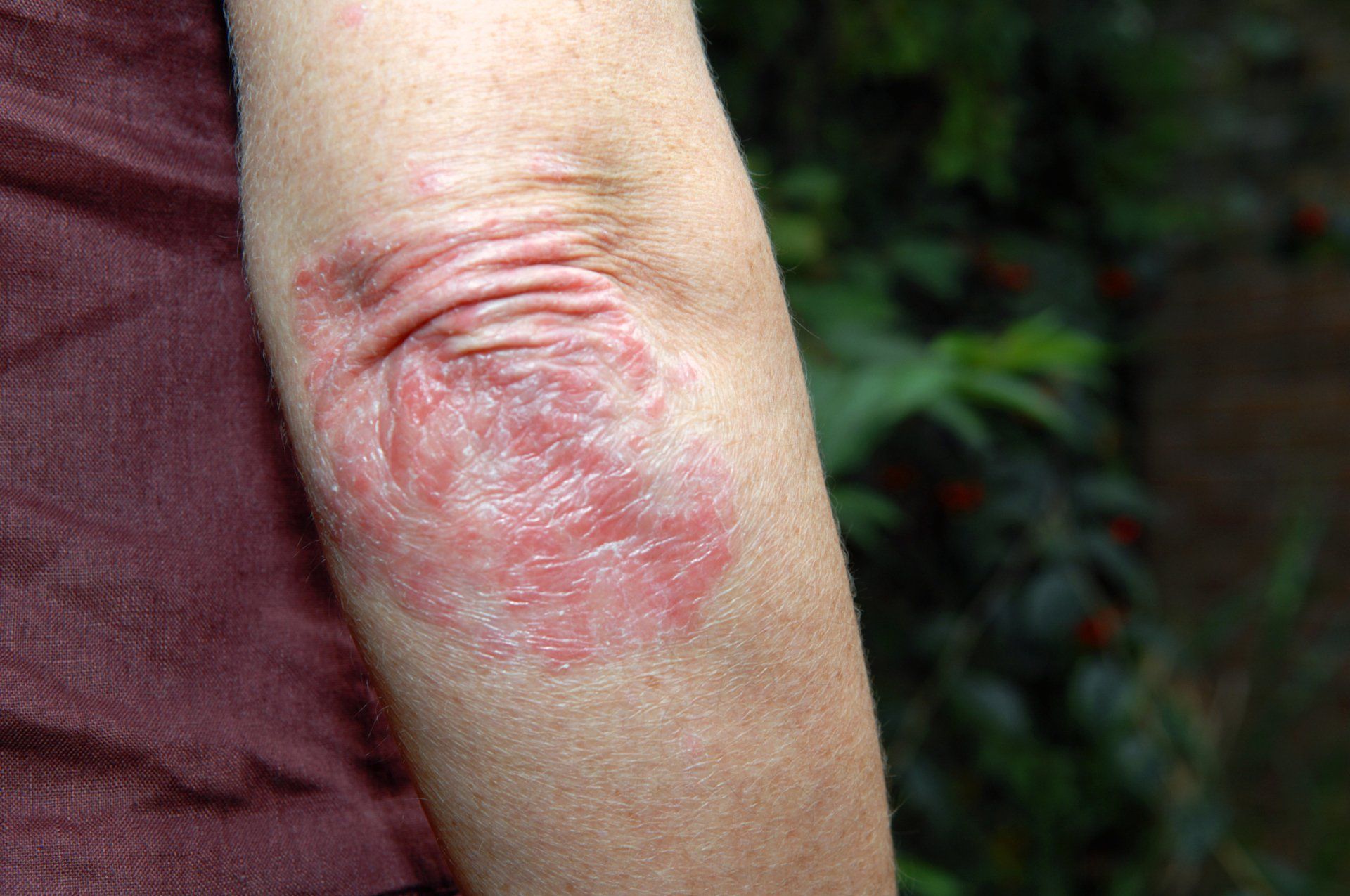 Rash — DeSoto TX — Allergic Diagnostic & Treatment Clinic