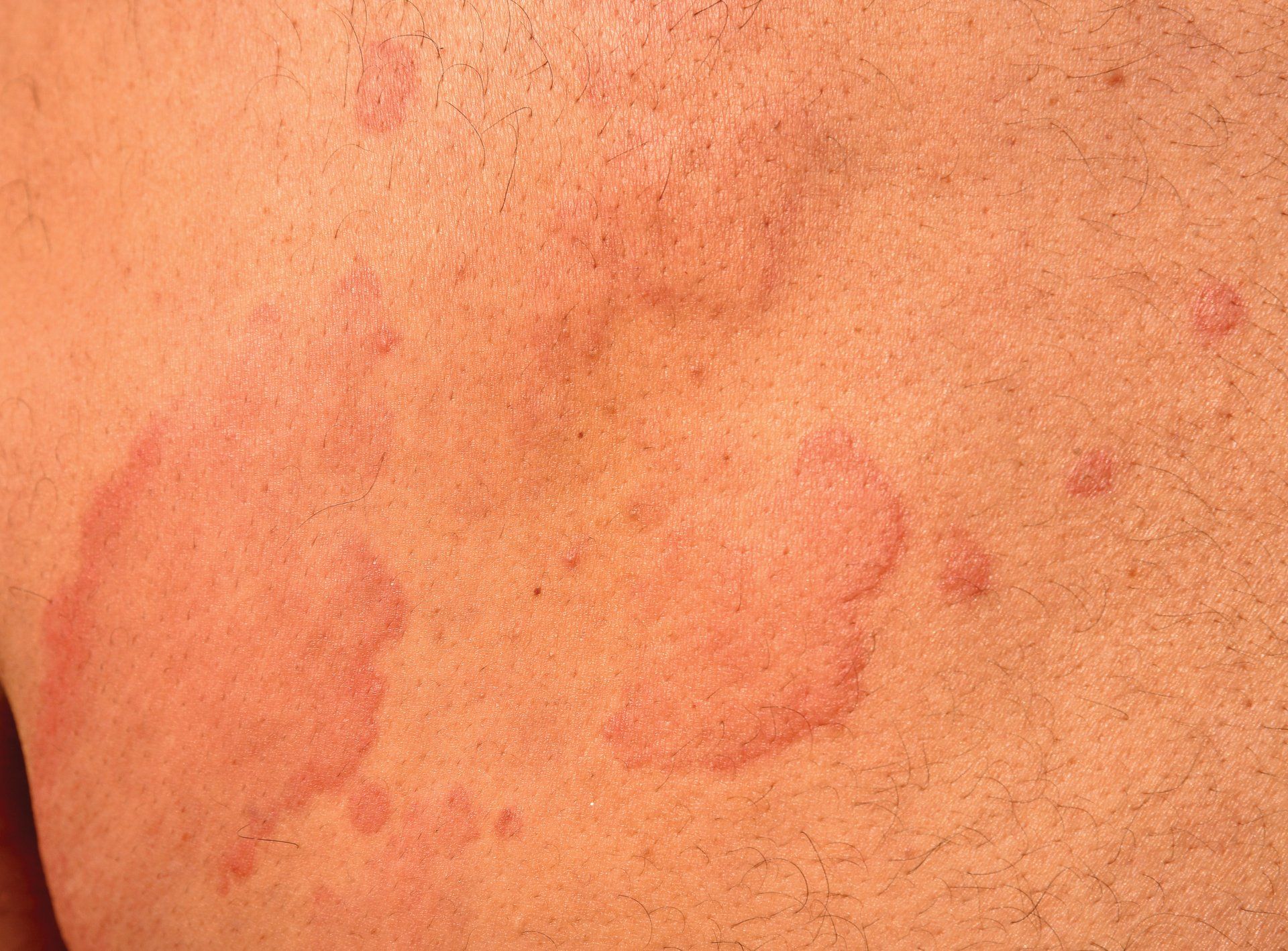 Hives — DeSoto TX — Allergic Diagnostic & Treatment Clinic