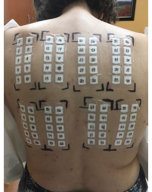 Allergy Patch Testing — DeSoto TX — Allergic Diagnostic & Treatment Clinic