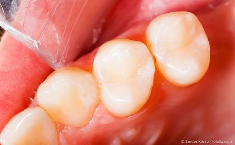 Weiße Zahnfüllungen - Inlay oder Komposit - Dorow Clinic