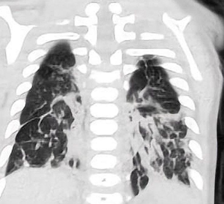 Interstitial lung disease in a patient with MSMDS
