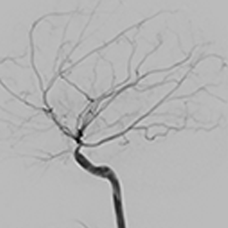 Moyamoya-like is a term that is often used to describe MSMDS brain vasculature