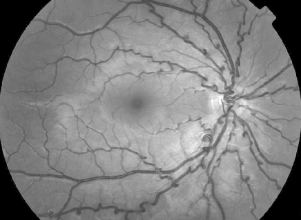 Moyamoya-like is a term that is often used to describe MSMDS brain vasculature