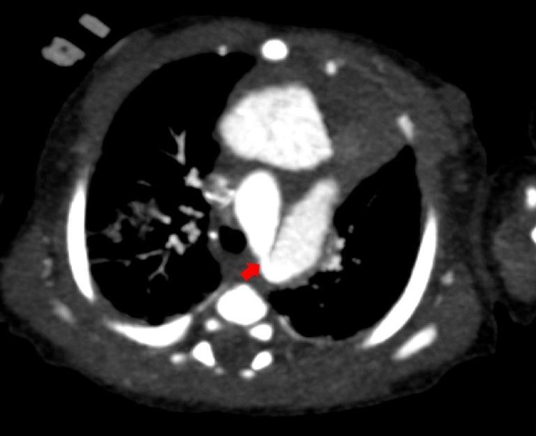 Aortic coarctation as early sign of MSMDS