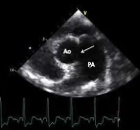 Aortopulmonary window as early sign of MSMDS