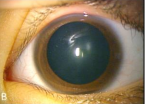 Dilated pupils as early sign of Multisystemic Smooth Muscle Dysfunction Syndrome
