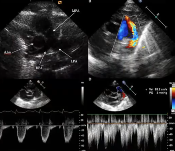 PDA repair needed as early sign of MSMDS