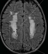 White matter abnormalities are usually present as early symptom of MSMDS
