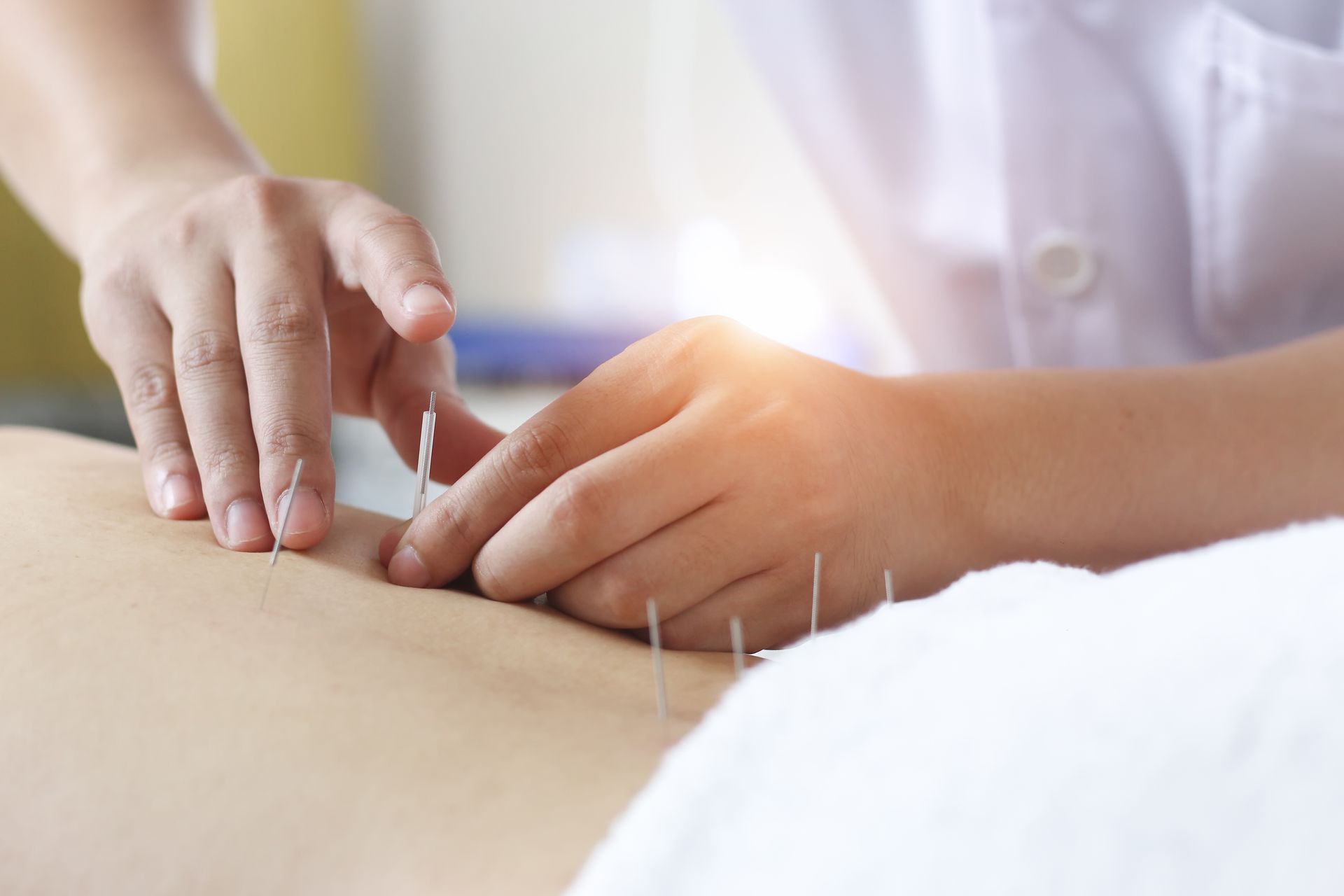 Acupuncturist inserting needles into a patient's back; close-up shot in a medical setting.