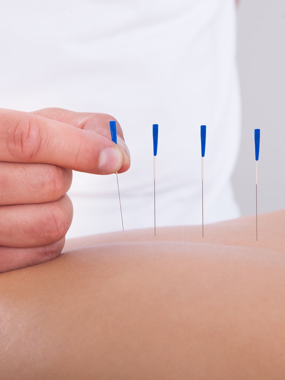a person is getting acupuncture on their arm .