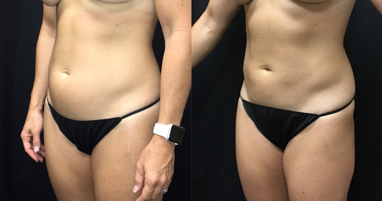 Before-and-after shots of a woman's torso. Abdomen appears more toned in the second shot. Black background.