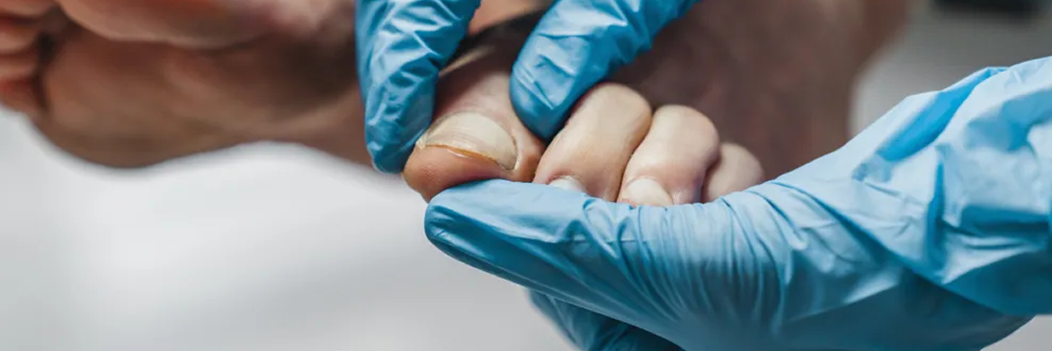A person wearing blue medical gloves examines a foot, focusing on the toes and toenails.