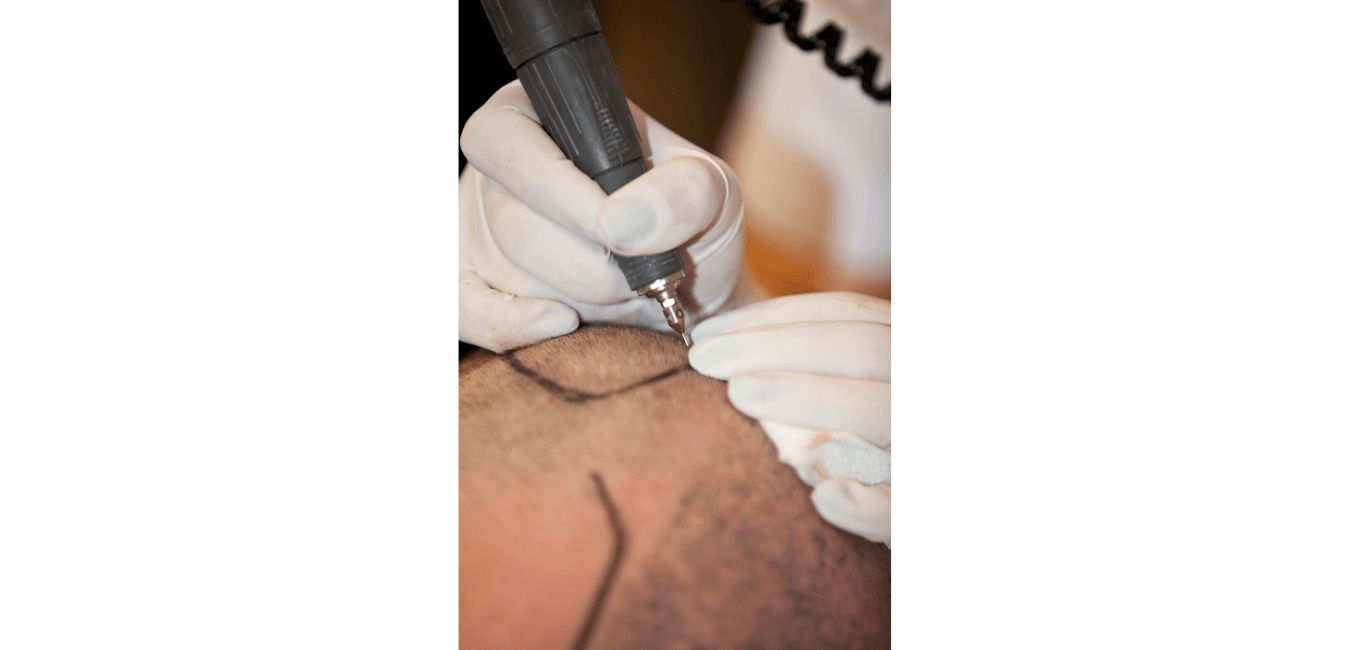 A client working with a Hair Transplant Birmingham independent specialist