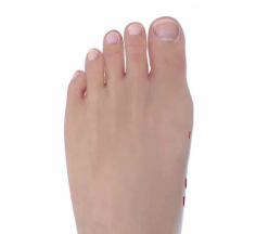 foot with incision marker for beach bunionectomy