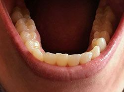 A close up of a person 's teeth with their mouth open.