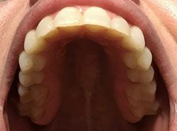 A close up of a person 's mouth with their teeth showing.