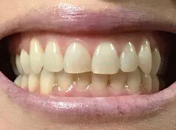 A close up of a person 's teeth with white teeth.