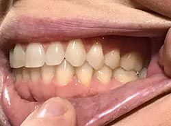 A close up of a person 's mouth with white teeth.