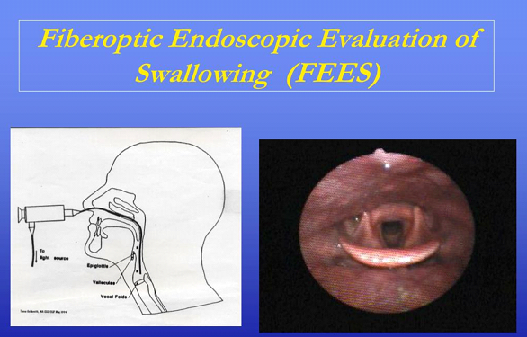 Fiberoptic endoscopic evaluation of swallowing fees is shown