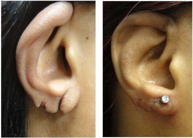 Earlobe Repair in Jodhpur  Suture Free Earlobe Repair Treatment