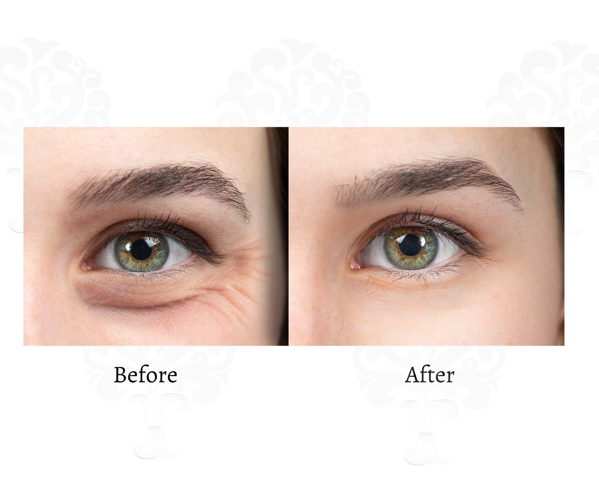 A before and after image of crows feet around the eyes.