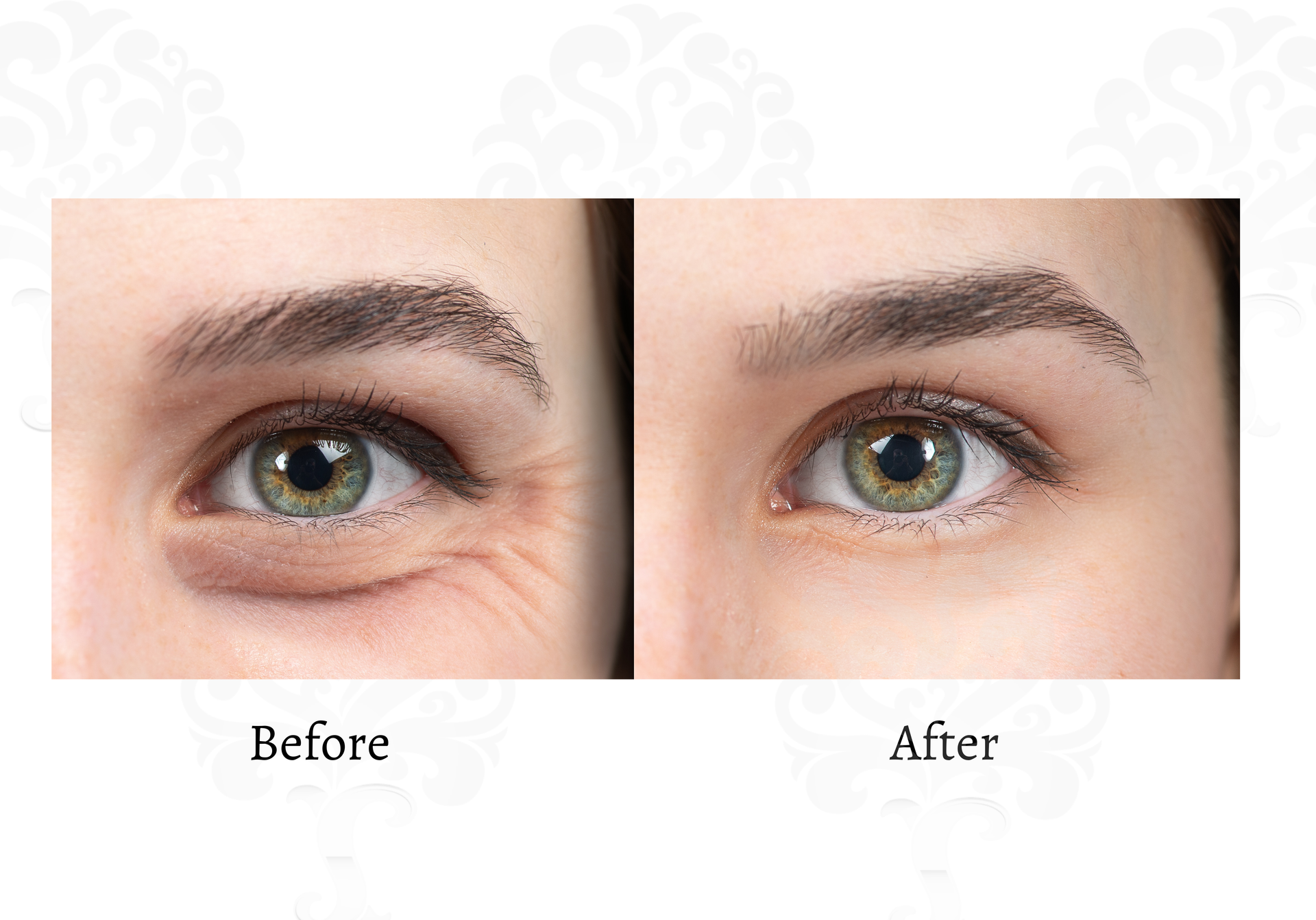A before and after image of crows feet around the eyes.