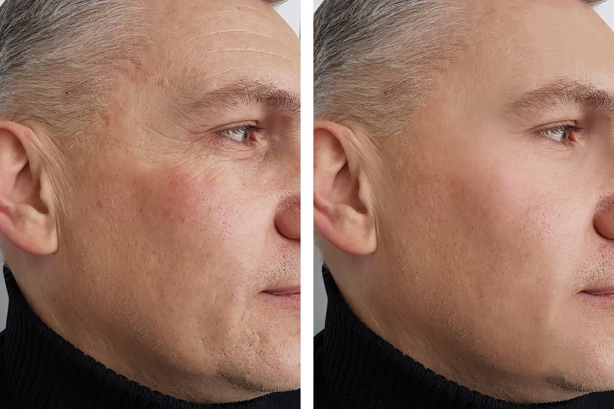 Photos comparing a patient’s results with Dysport before and after treatment at Modern Dermatology of KY near Lexington, Kentucky (KY)