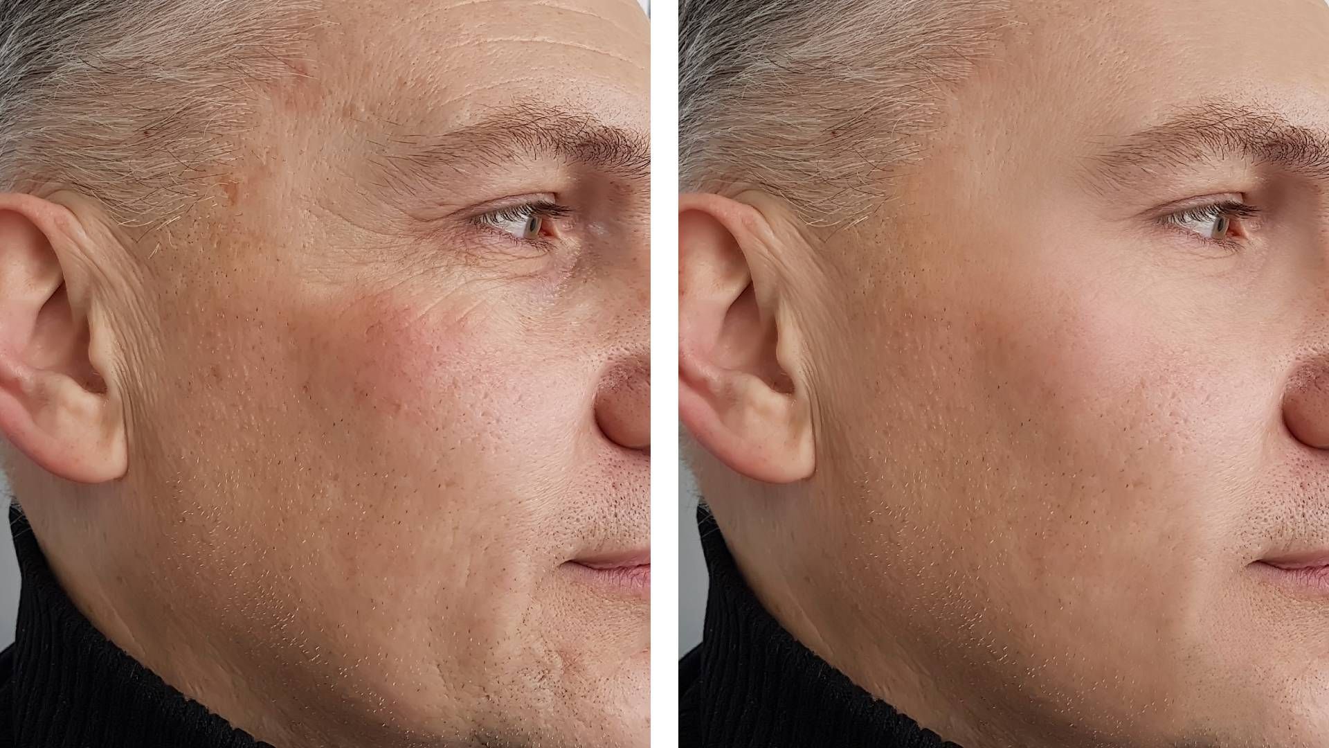 Photos comparing a patient’s results with Dysport before and after treatment at Modern Dermatology o