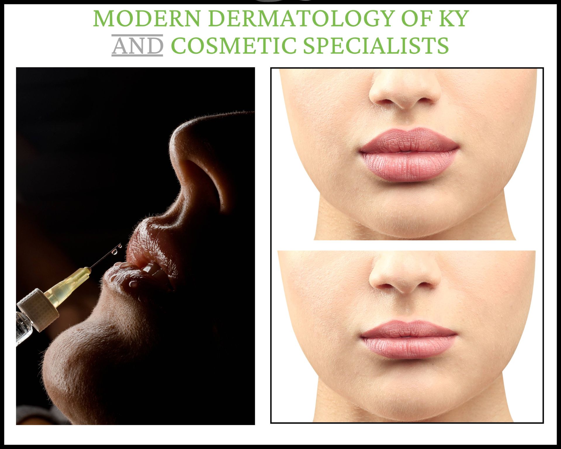 Lip Flip Before & After Photo near Lexington, Kentucky (KY)
