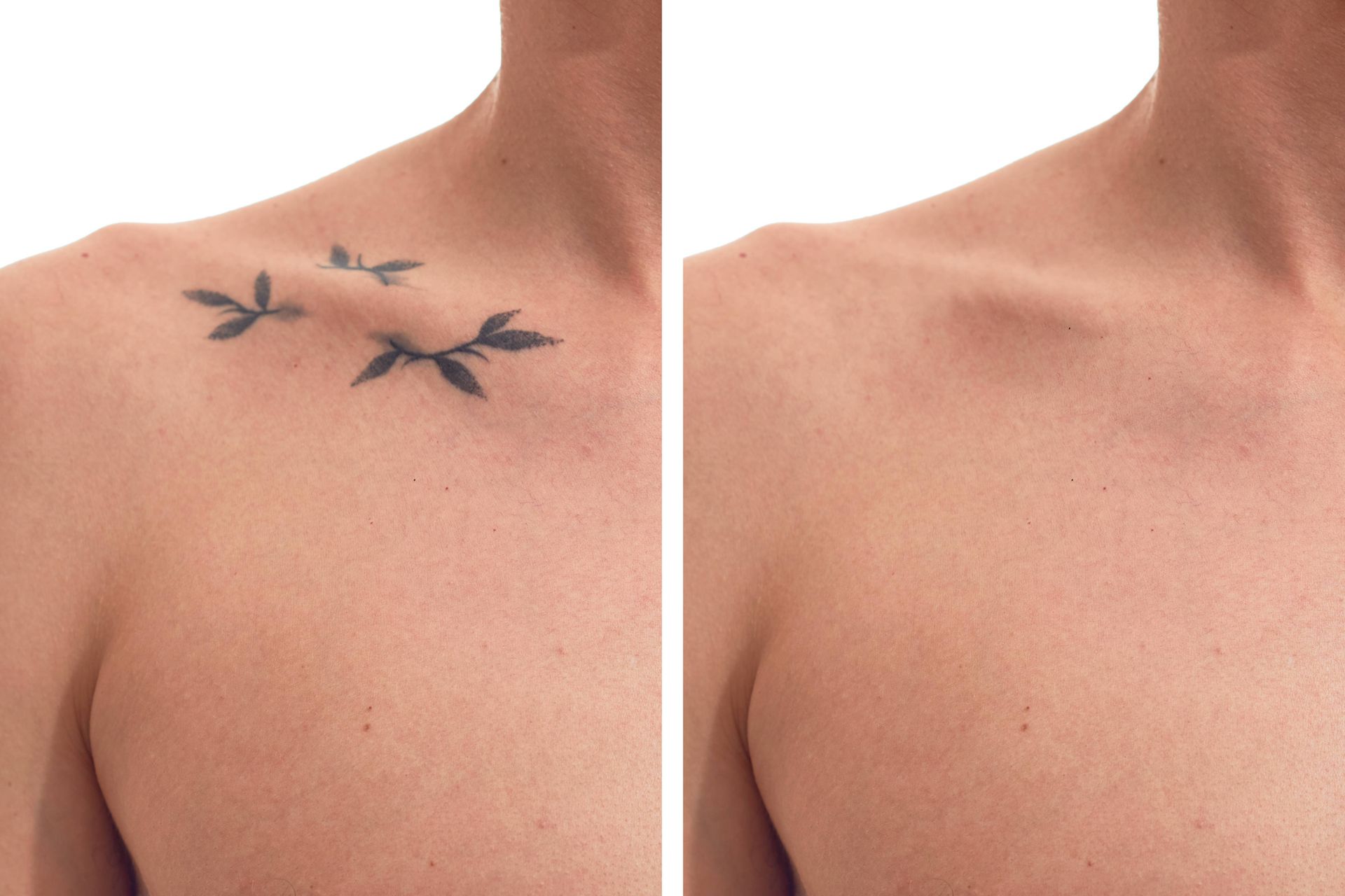 Before and after of a shoulder tattoo removal journey near Lexington, Kentucky (KY)