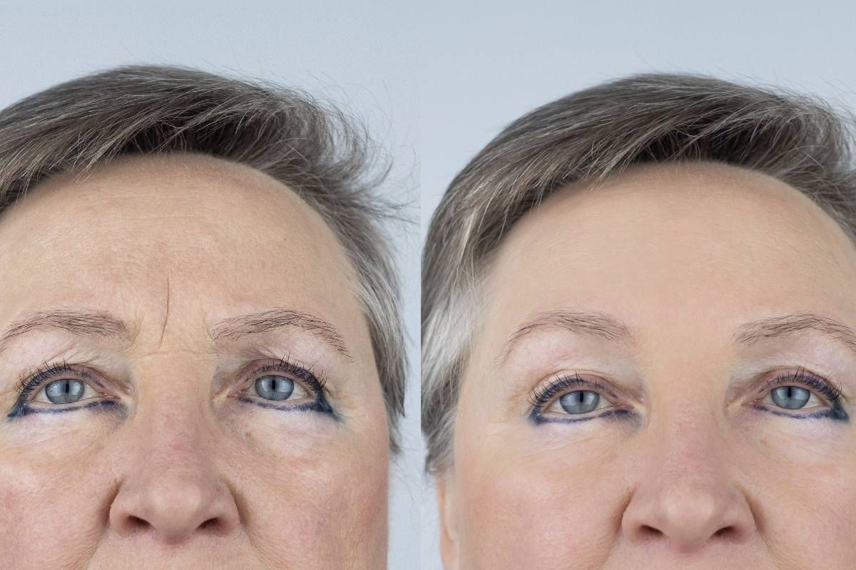 A woman’s 7 day Botox results near Lexington, Richmond, Paris, & London, Kentucky (KY)
