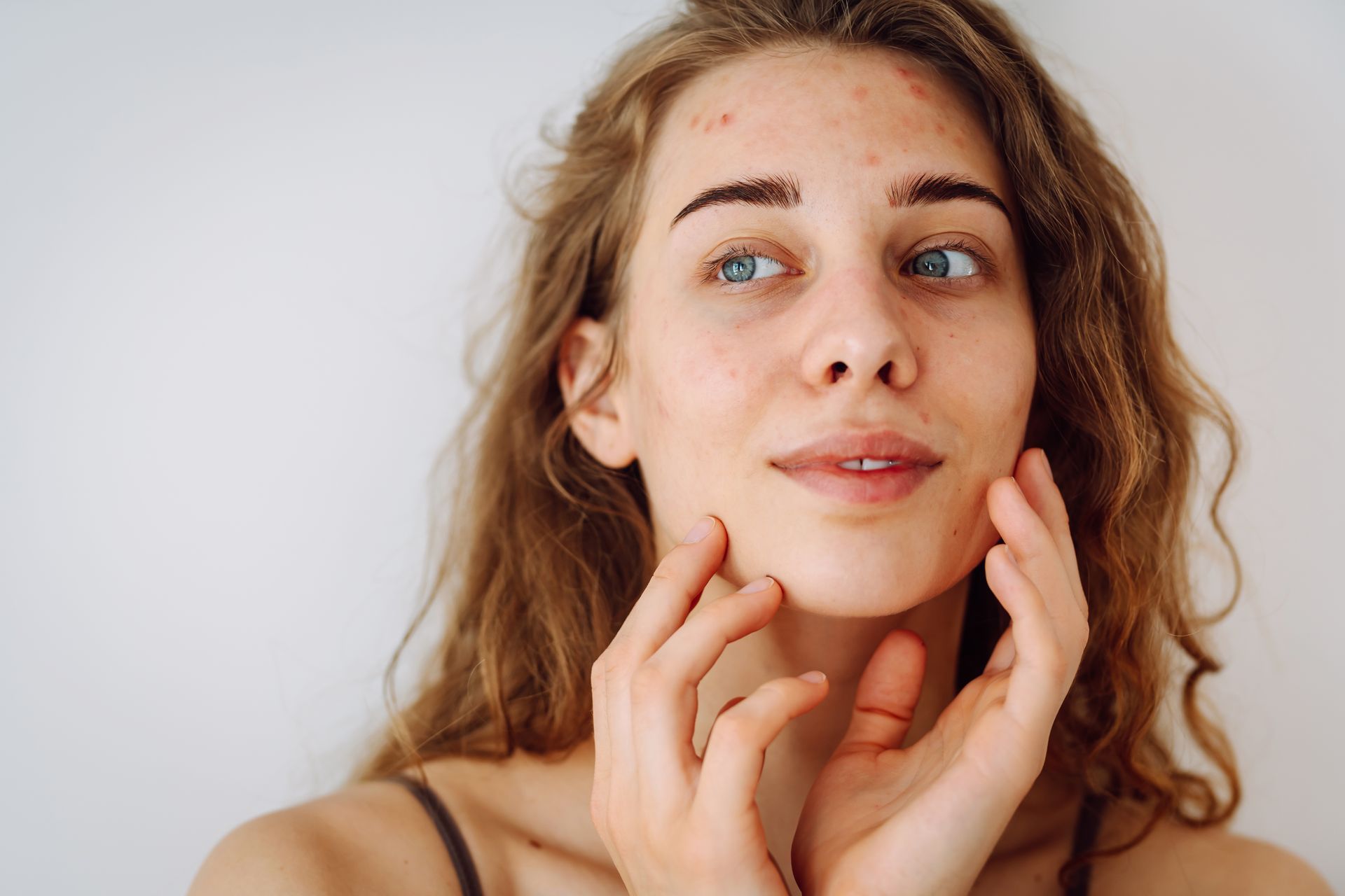 Smiling woman with acne