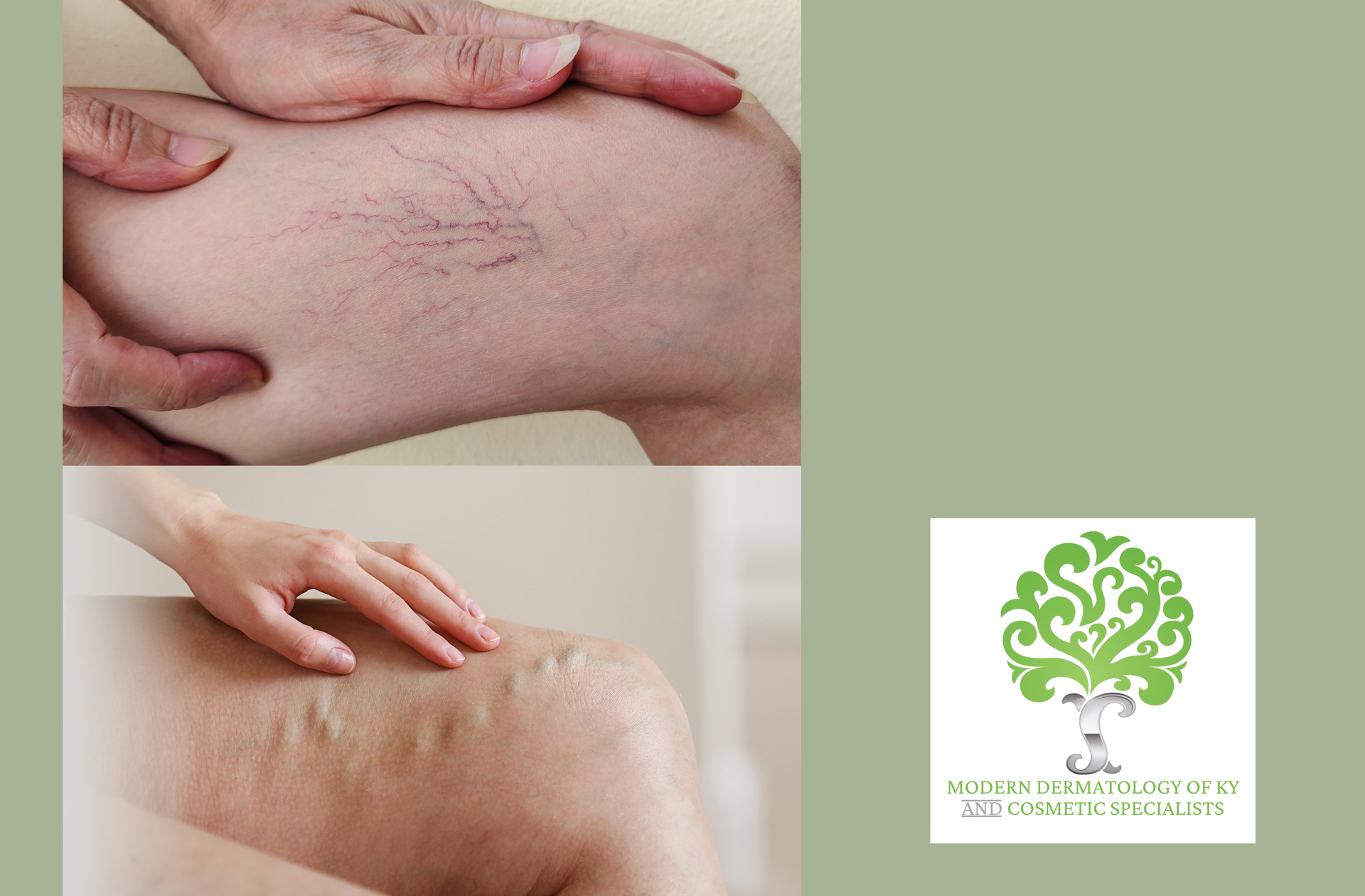 Spider veins vs varicose veins