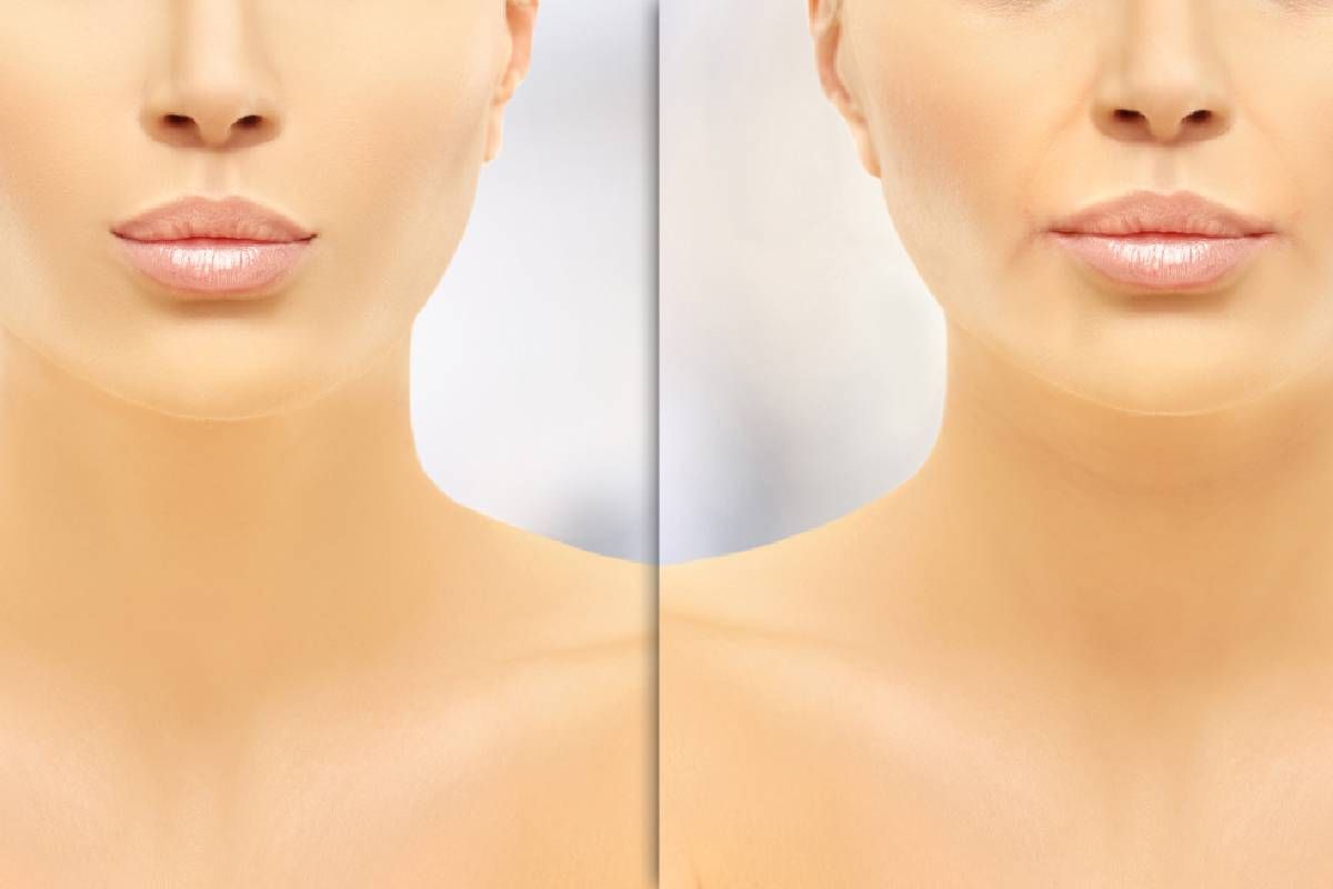  A woman’s face with Restylane Before and After near Lexington, London, Richmond, and Paris, Kentucky (KY)